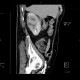 Pyelonephritis, kidney, follow-up: CT - Computed tomography